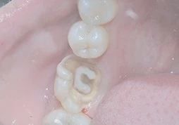 深圳根管治療推薦