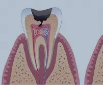 深圳根管治療推介