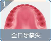 香港allon4種植牙推薦