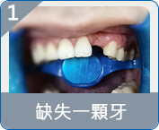 羅湖全口重建邊度好