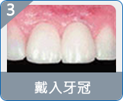 福田半口假牙費用