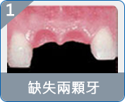 福田半口假牙費用