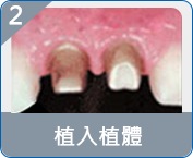 福田半口假牙費用