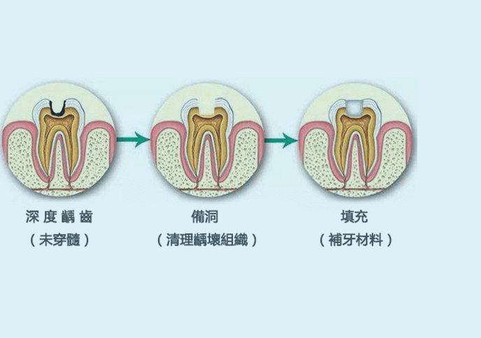 深圳補牙