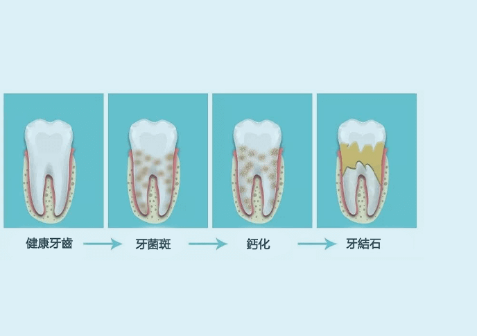 羅湖洗牙