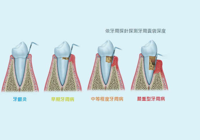 深圳洗牙